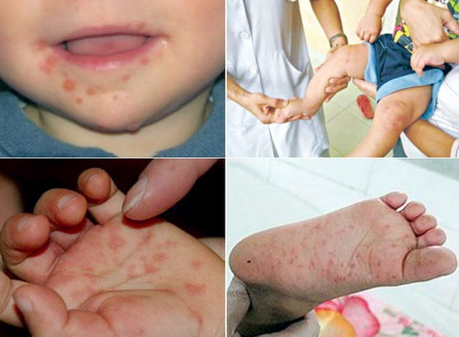 Vệ sinh cá nhân sạch sẽ giúp phòng bệnh tay chân miệng. Vệ sinh cá nhân sạch sẽ giúp phòng bệnh tay chân miệng.