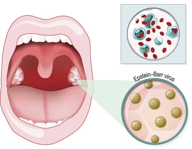 Bệnh bạch cầu đơn nhân nhiễm khuẩn do siêu vi khuẩn Epstein-Barr (EBV)