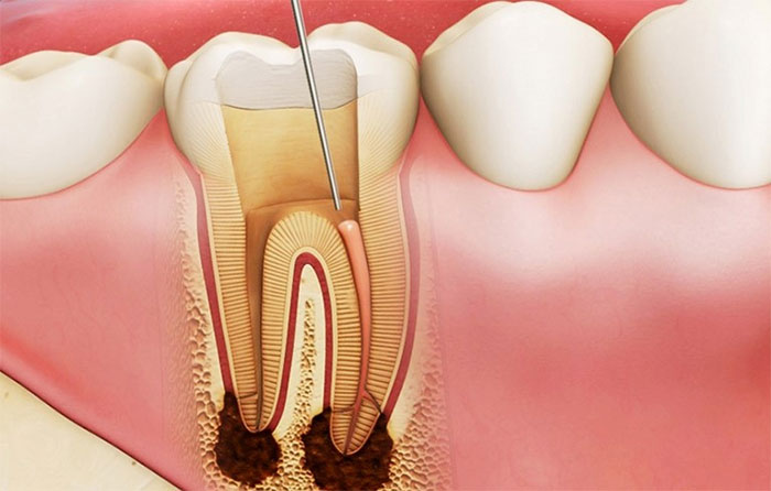 sau-rang Viêm lợi nếu không được điều trị đúng sẽ có những biến chứng có thể làm sâu răng, mất răng.