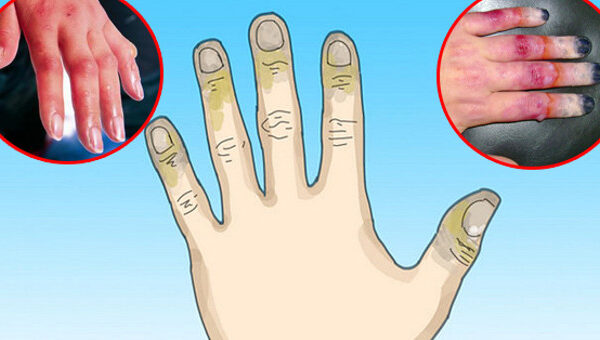 Cách chữa trị cho người bị bỏng lạnh