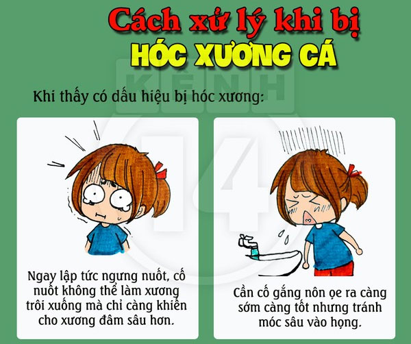 Cách xử lý "chuẩn không cần chỉnh" khi bị hóc xương cá